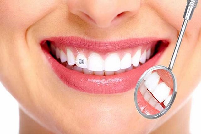 Invisalign braces