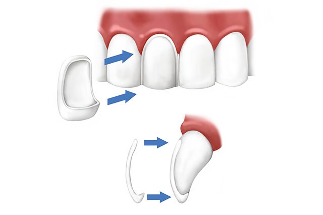 Invisalign braces