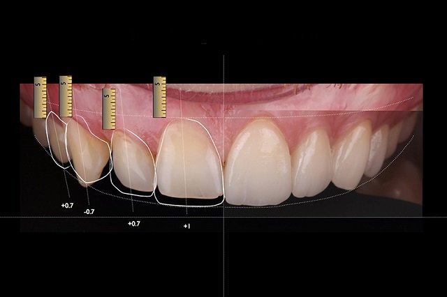 Invisalign braces
