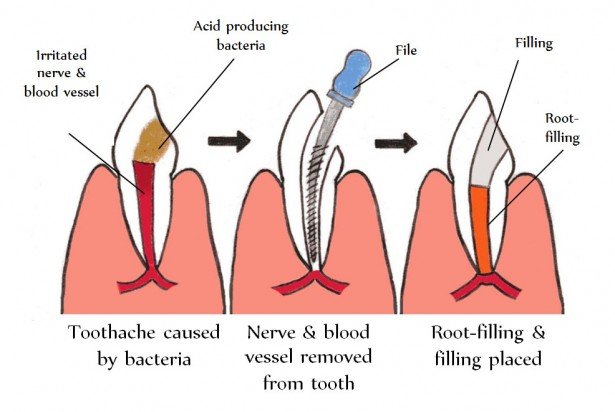 Invisalign braces