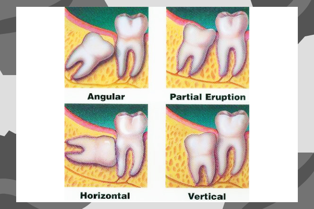 Invisalign braces