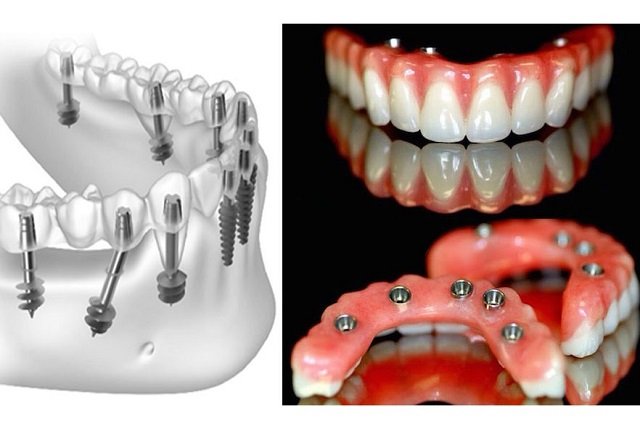 Invisalign braces