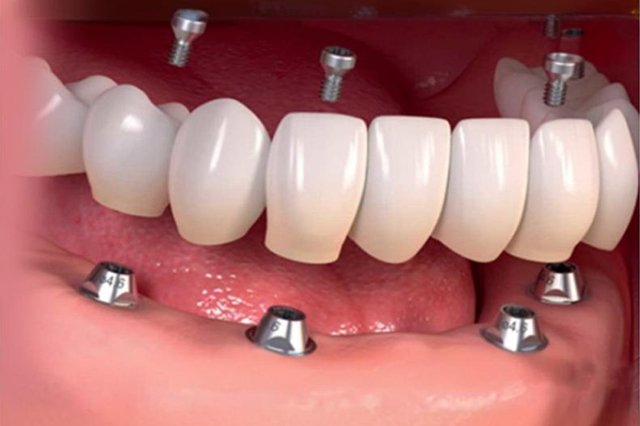 Invisalign braces