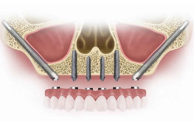 Invisalign braces