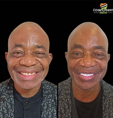Invisalign braces