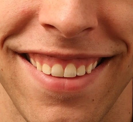 Invisalign braces