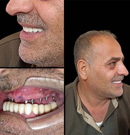 Invisalign braces