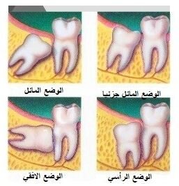 اوضاع ضرس العقل