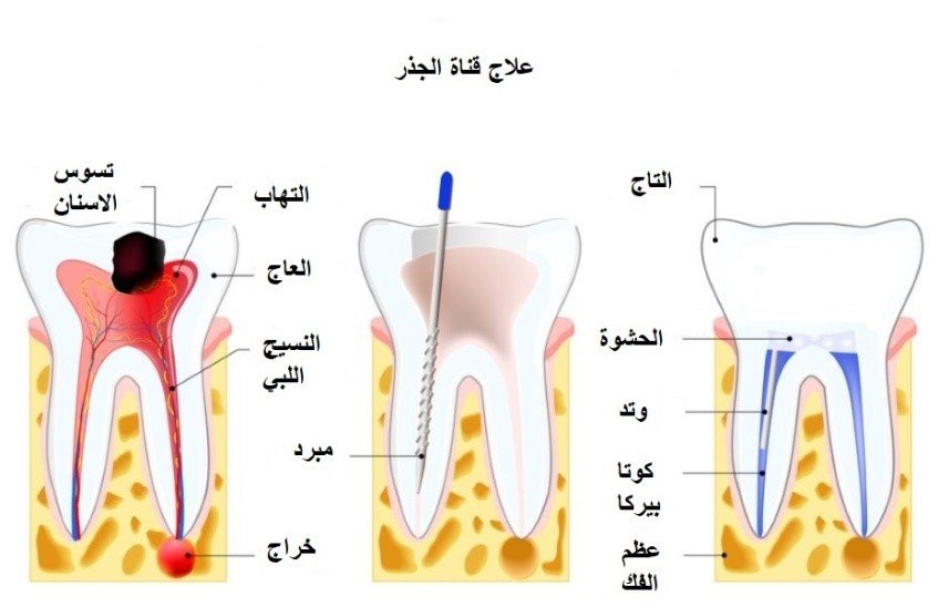 علاج قناة الجذور في الهند
