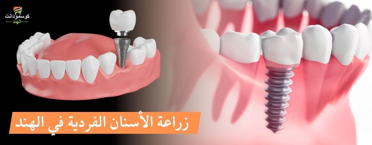 زراعة السن الواحد في الهند