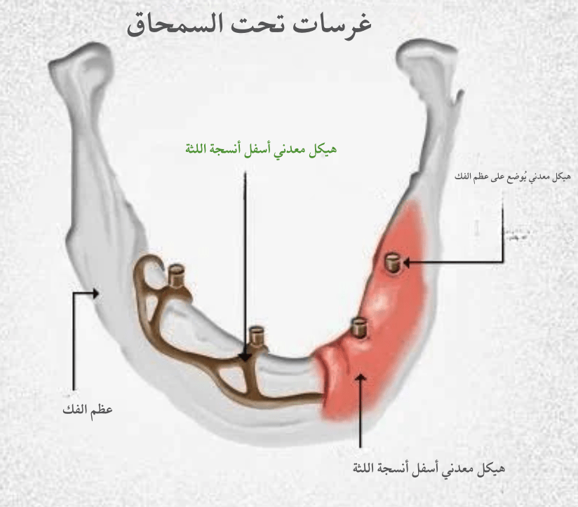 أنواع زراعة الأسنان أنواع زراعة الأسنان