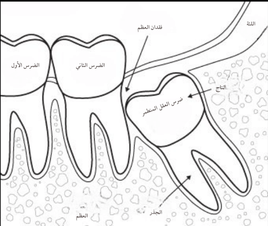 ازالة ضرس العقل في الهند ازالة ضرس العقل في الهند