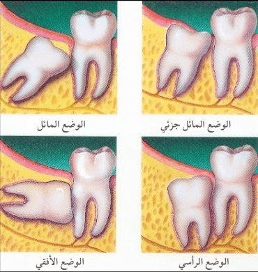 خلع أسنان العقل في الهند خلع أسنان العقل في الهند