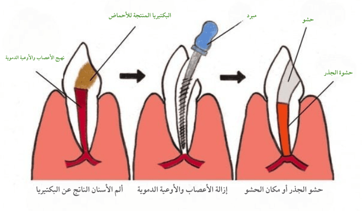 علاج قناة الجذر بدون ألم في الهند علاج قناة الجذر بدون ألم في الهند