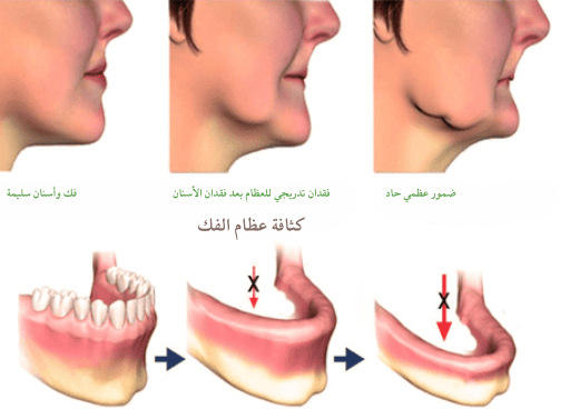 عملية زراعة سن واحد عملية زراعة سن واحد