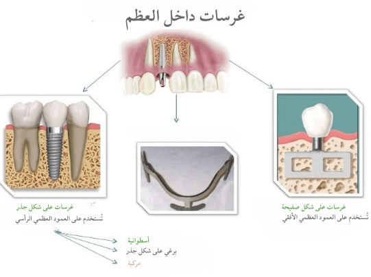 واع زرعات الأسنان الكاملة في الهند واع زرعات الأسنان الكاملة في الهند