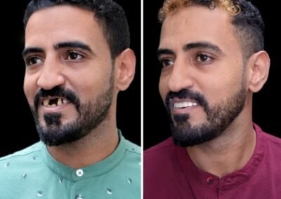 أفضل طبيب لزراعة الأسنان القاعدية في الهند