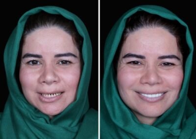 بتسامة هوليود الهند