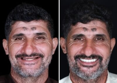 بعد قبل زراعة الأسنان الكاملة