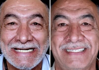 بعد قبل زراعة الأسنان الكل على أربعة