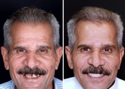 بعد و قبل زراعة الأسنان الوجنية في الهند