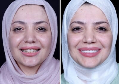 تصميم ابتسامة هوليوود