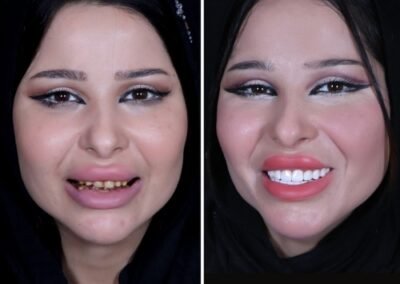 تصميم الابتسامة مع أفضل طبيب الدكتور أمان