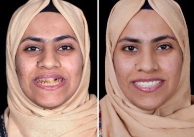 تكلفة زراعة الأسنان الوجنية في الهند