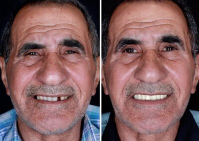 تكلفة زراعة سن واحد في الهند