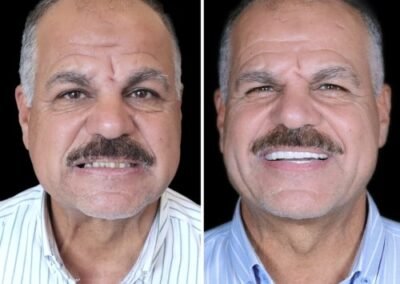 تكلفة علاج زراعة الأسنان القاعدية في الهند