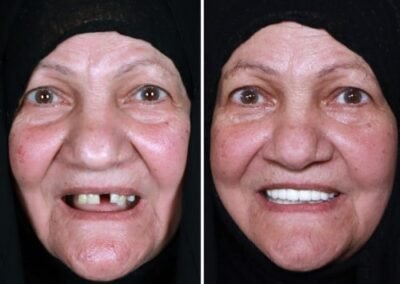 زراعة الأسنان الفورية في الهند