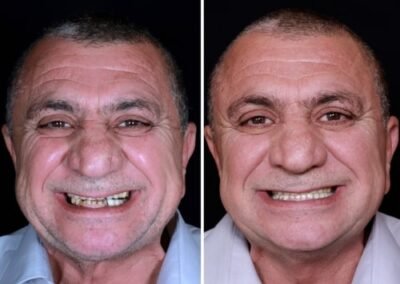زراعة الأسنان القاعدية في الهند