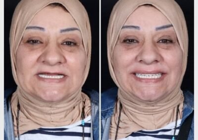 زراعة الأسنان الكاملة في الهند