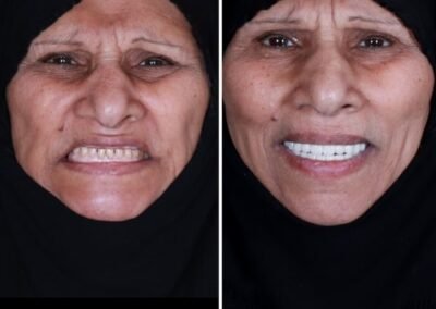 زراعة الأسنان الكل على أربعة في الهند