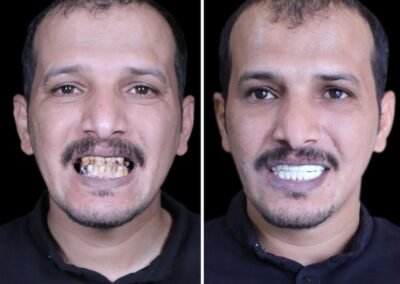 زراعة الأسنان الوجنية في الهند
