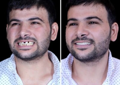 زراعة السن الواحد في الهند