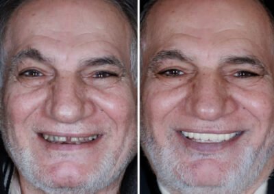 زراعة فورية سن واحد في الهند