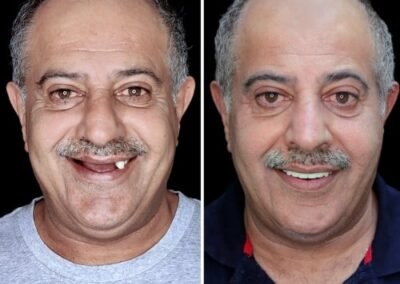 علاج زراعة الأسنان الكاملة في الهند