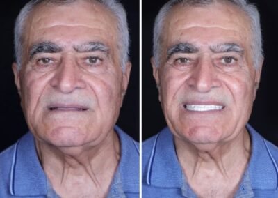 علاج زراعة الأسنان الكل على أربعة في الهند