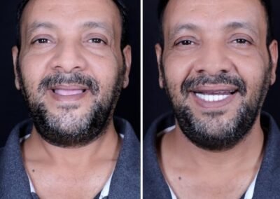 قبل وبعد زراعة الأسنان الكاملة