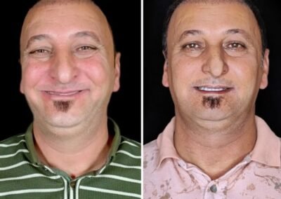 قبل وبعد زراعة الأسنان الكل على أربع