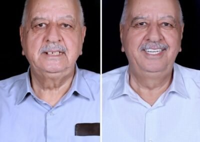 إجراءات علاج قناة الجذر
