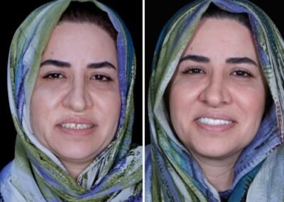 علاج قناة الجذر بدون ألم في الهند
