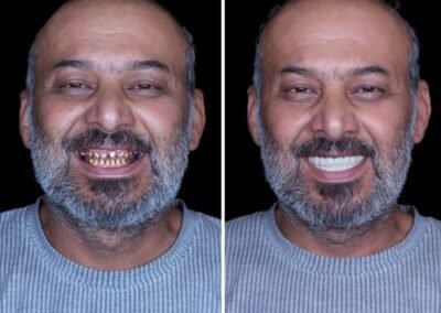 علاج قناة الجذر بدون ألم في جورجاون، الهند