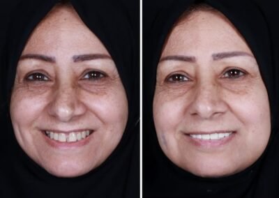 ابتسامة لثوية