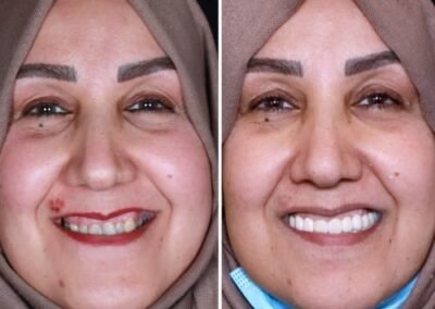 تصحيح الابتسامة اللثوية