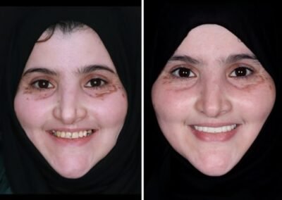 علاج الابتسامة اللثوية في الهند