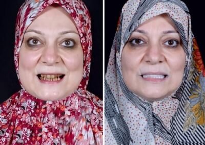 قشرة الأسنان