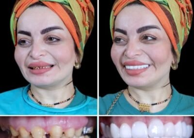 قشرة الأسنان في الهند